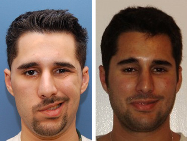 bell’s palsy before and after treatment