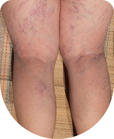 Best Treatments for Varicose Vein Relief and Healing