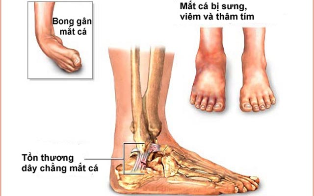 Nguyên nhân bong gân mắt cá