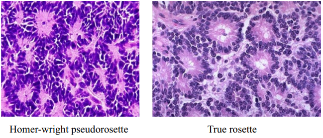 Medulloblastoma - Grade IV tumor 