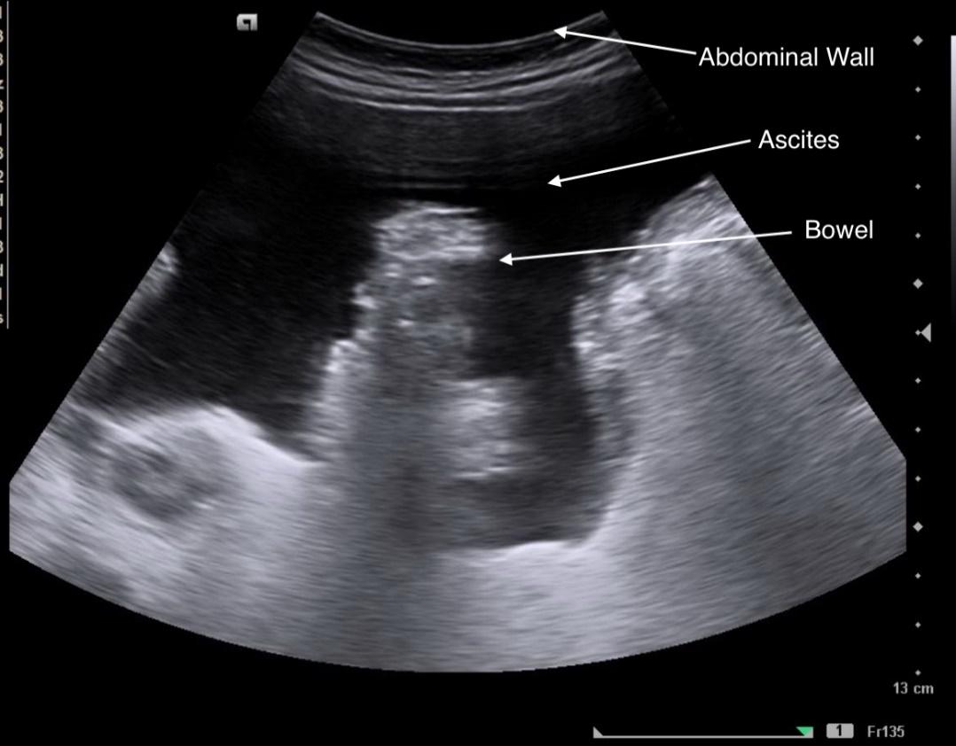 Condition Specific Radiology: Ascites - Stepwards