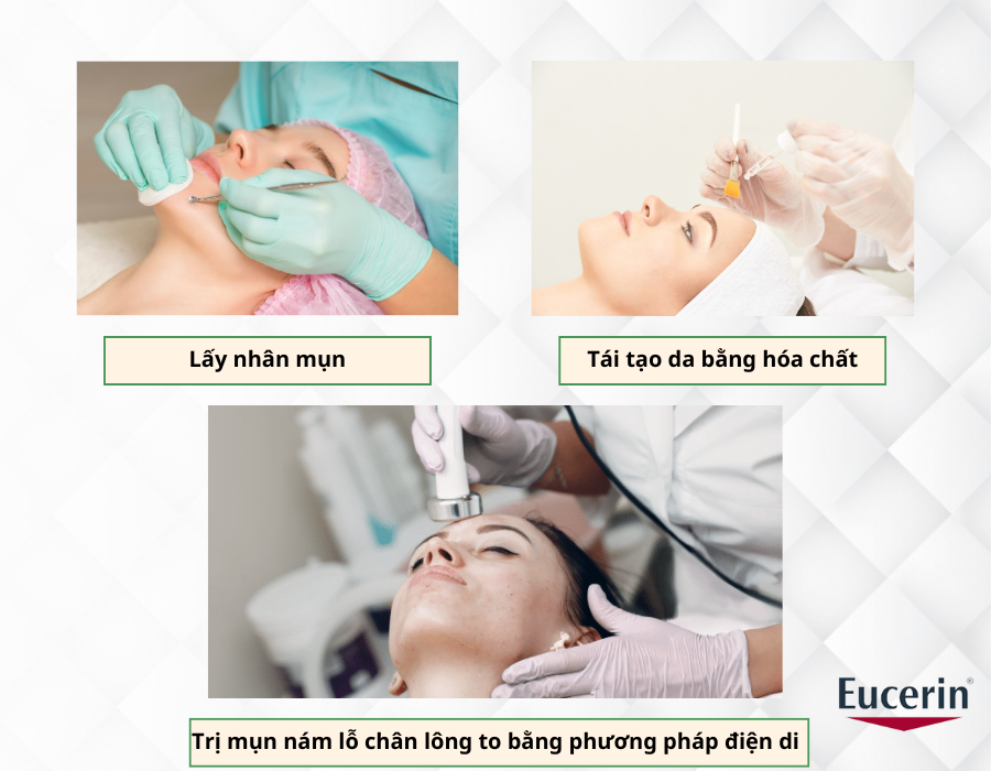 Các phương pháp điều trị mụn cám khác