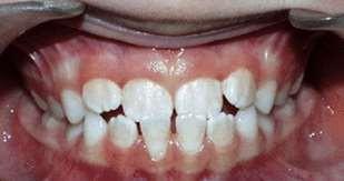 Correction d'une proalvÃ©olie infÃ©rieure par arc de base. Situation avant traitement en dentition mixte (a), en cours de traitement (b) et aprÃ¨s stabilisation et installation de la denture dÃ©finitive (c).Â 