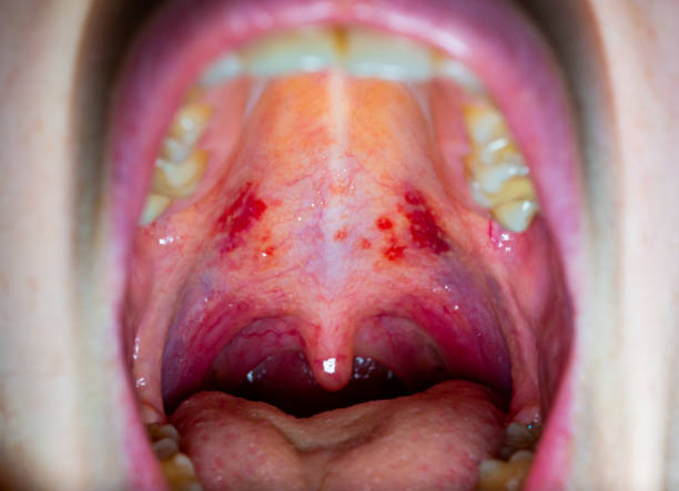 Red Spots on Roof of Mouth

