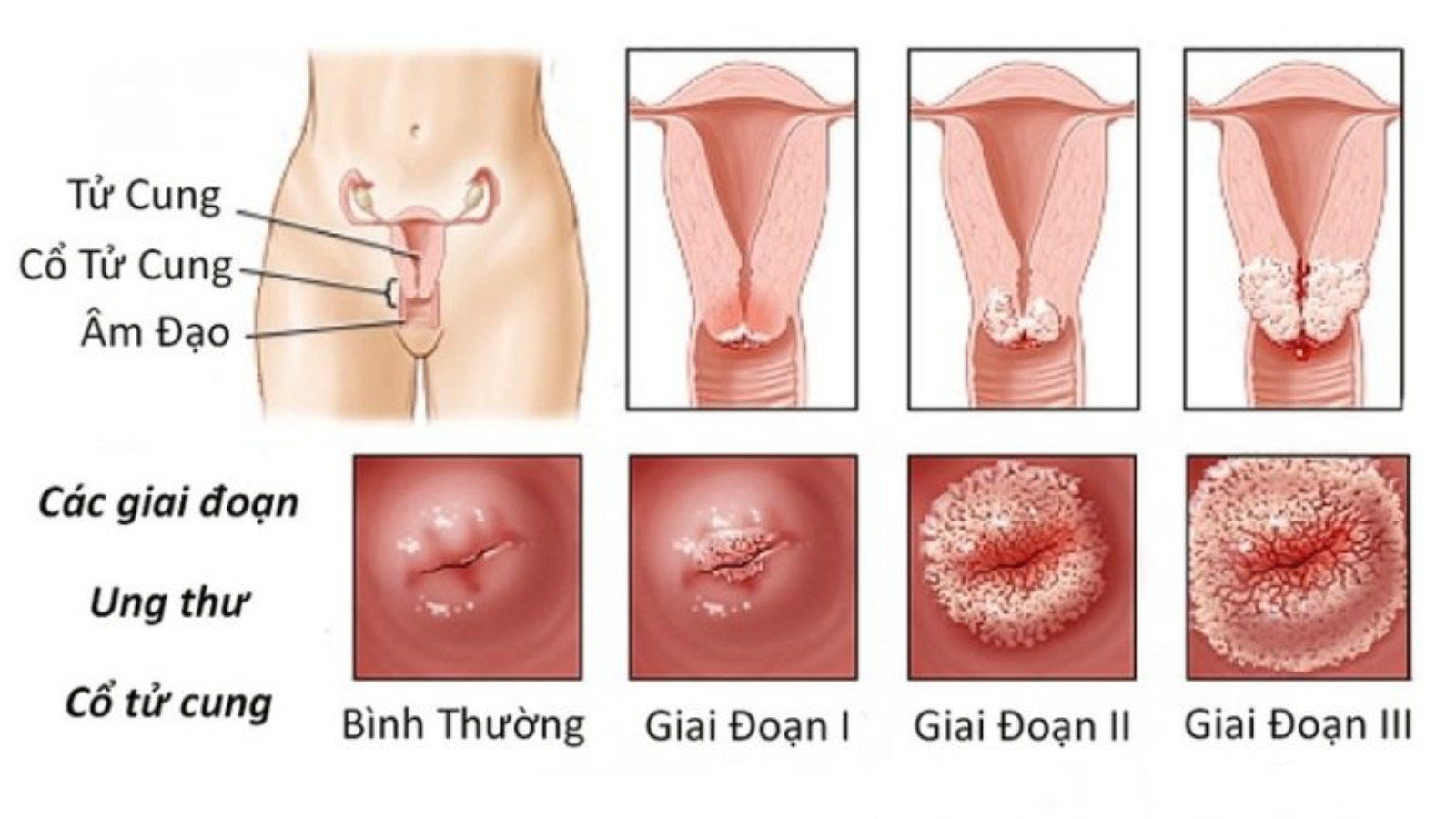 virus-papilloma-va-nhung-dieu-ban-can-biet 3