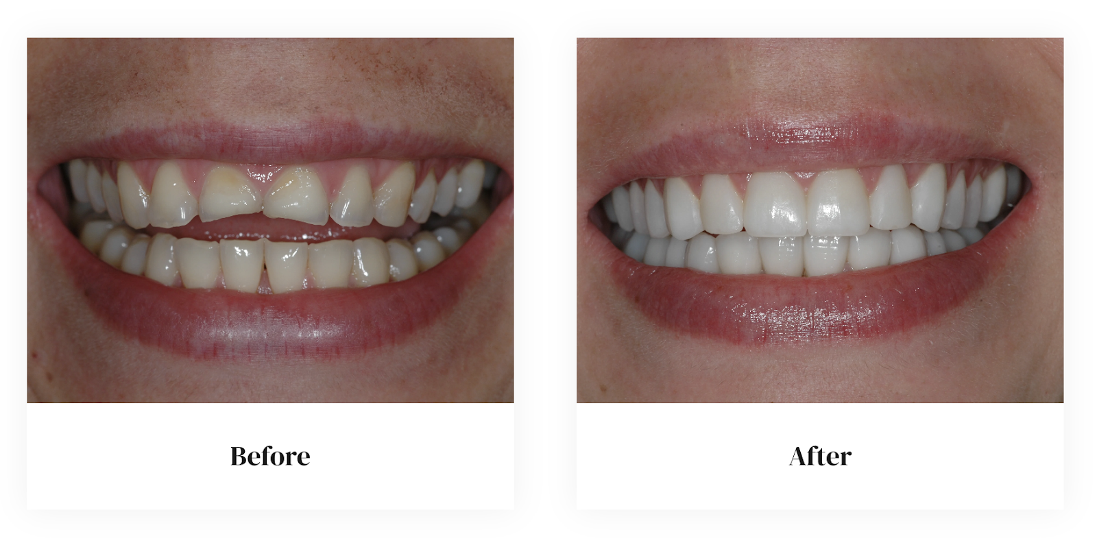 Veneer before and after case