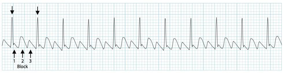 Atrial flutter with a 3-1 block