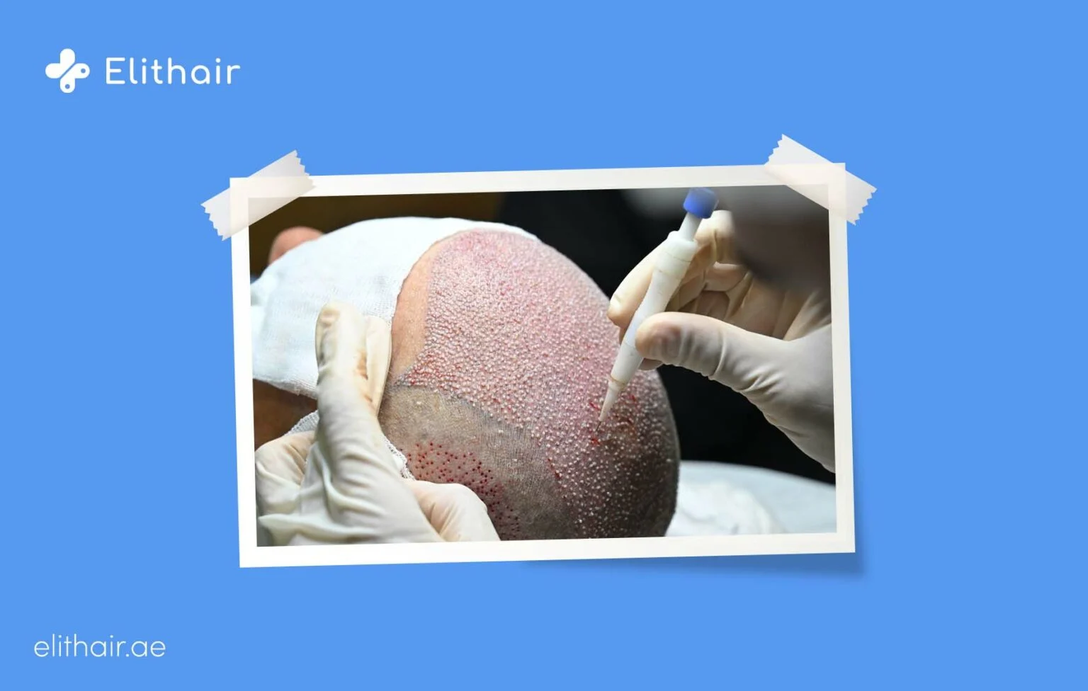 تقنية DHI أقلام تشوي - مركز اليت هير لزراعة الشعر