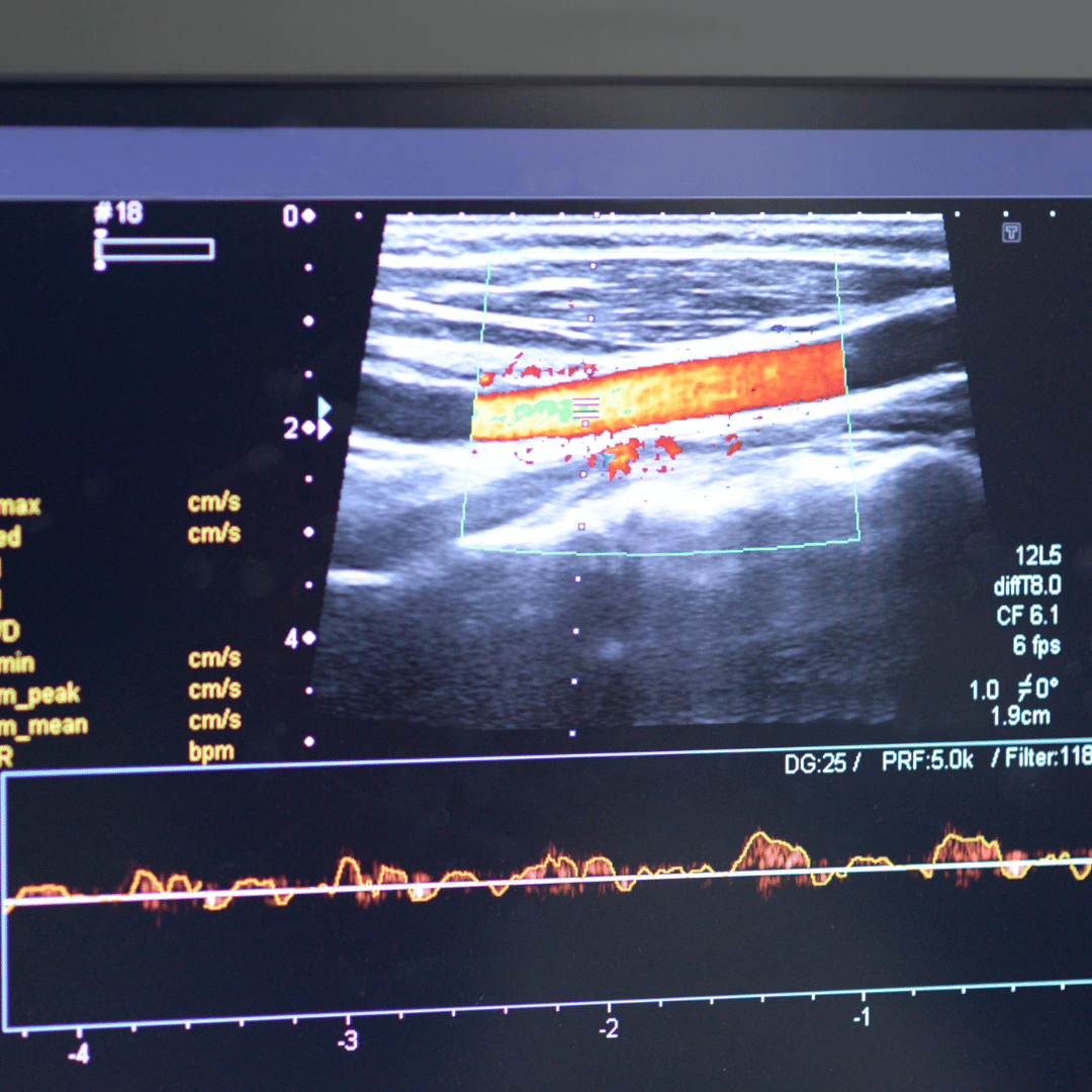 Vascular Ultrasound