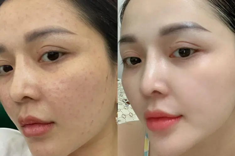 Công dụng của meso không kim