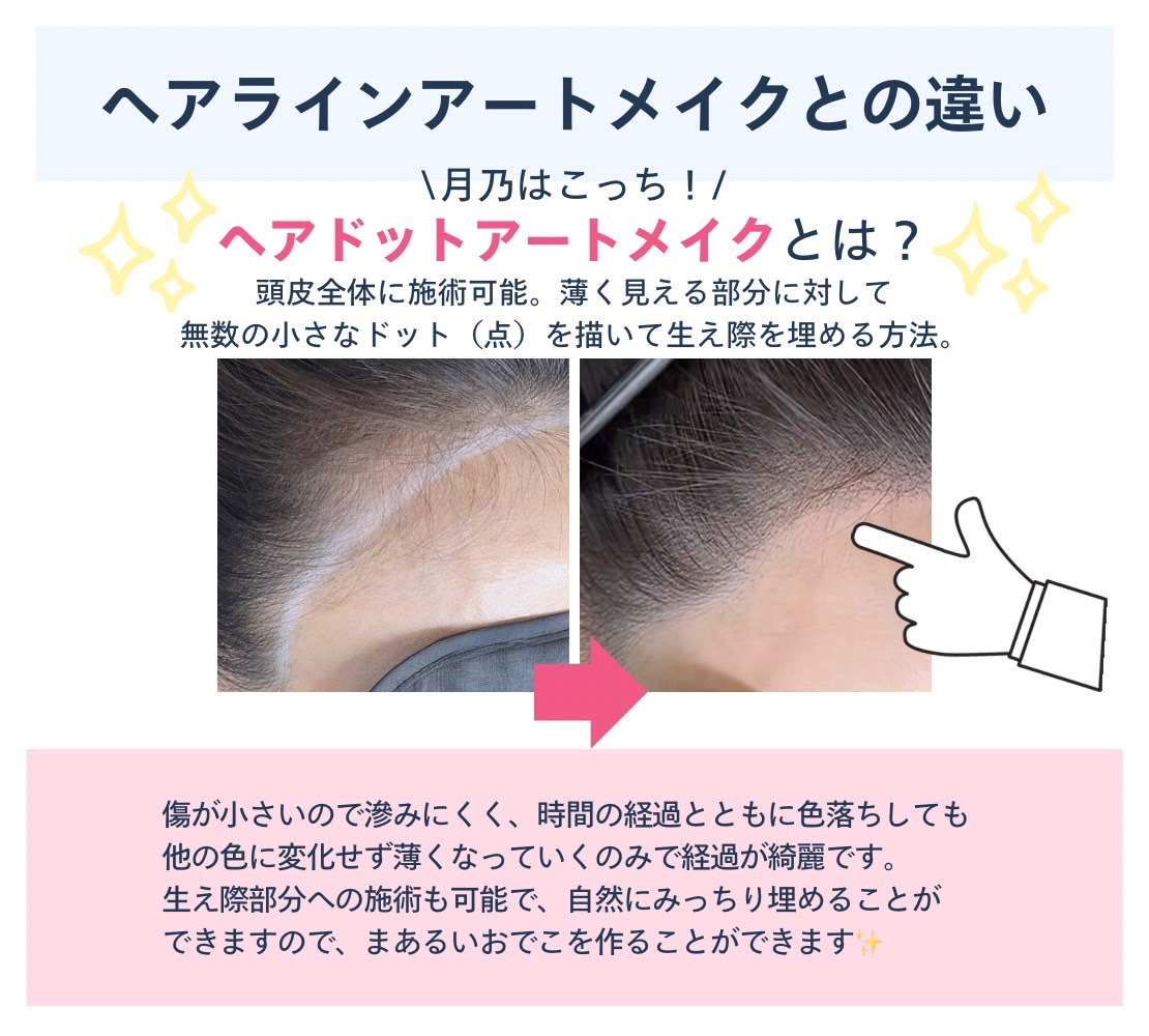 ヘアラインアートメイクとの違い