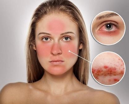 Nên sử dụng kem chống nắng phù hợp cho làn da nhạy cảm