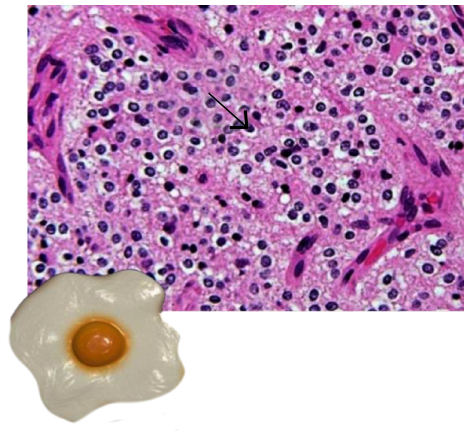 Fried egg appearance: nucleus and & Perinuclear hal