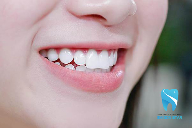 Răng Thỏ Là Gì? Làm Răng Sứ Thỏ Đẹp Tự Nhiên Phù Hợp Khuôn Mặt