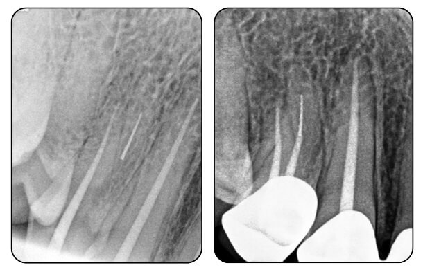 mohit endodontics