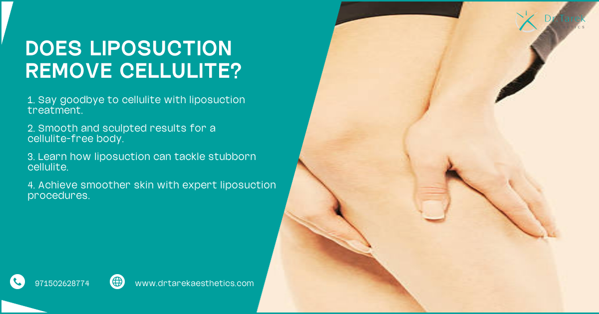 Does Liposuction Fix Cellulite