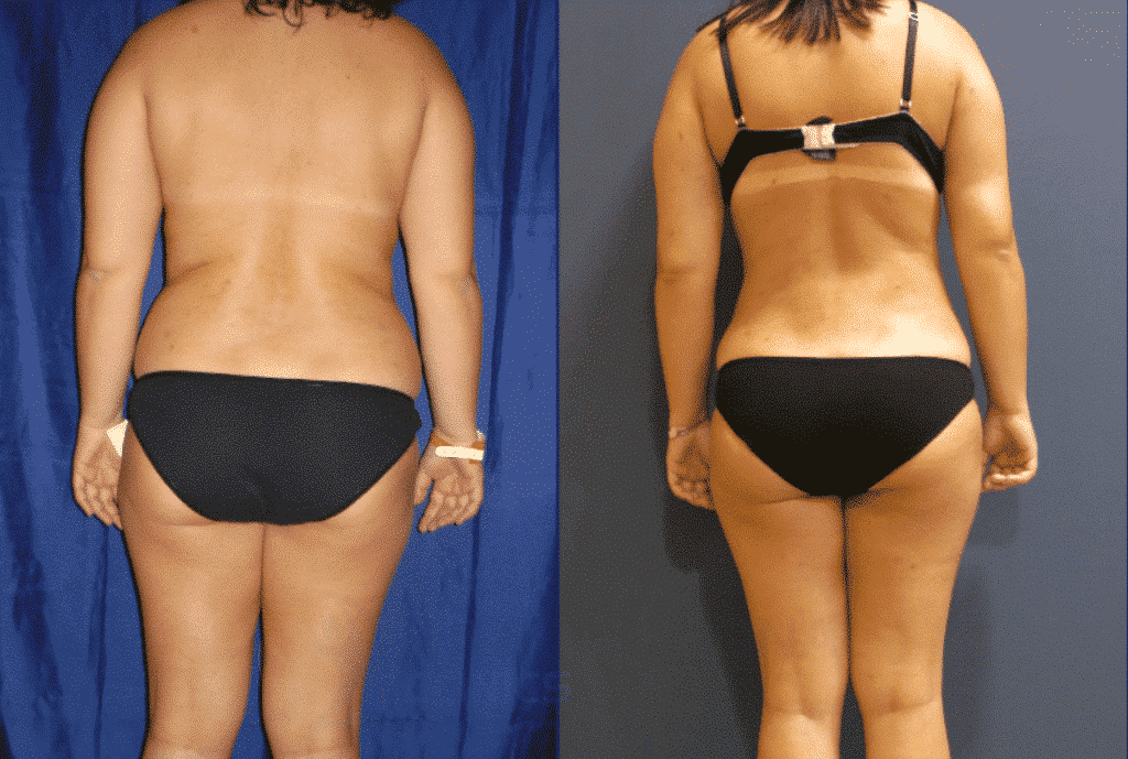 back liposuction before and after