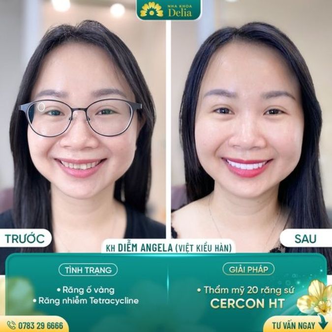 Ưu điểm của răng sứ Cercon HT