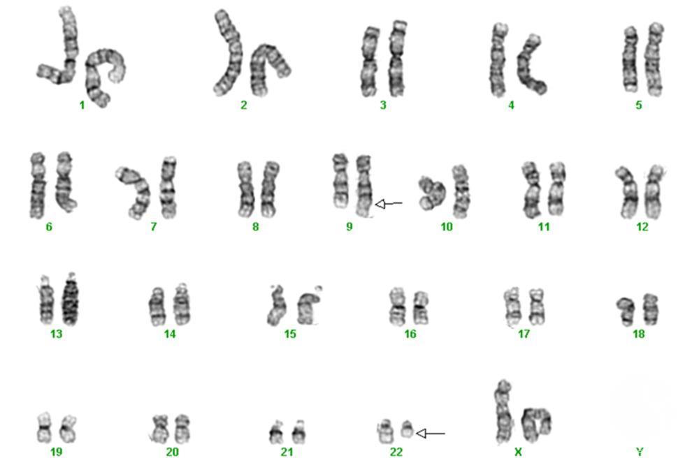 A karyotype of translocation between chromosome 22 and 9.