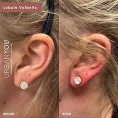 This contains an image of Ear Lobe Filler Before and After