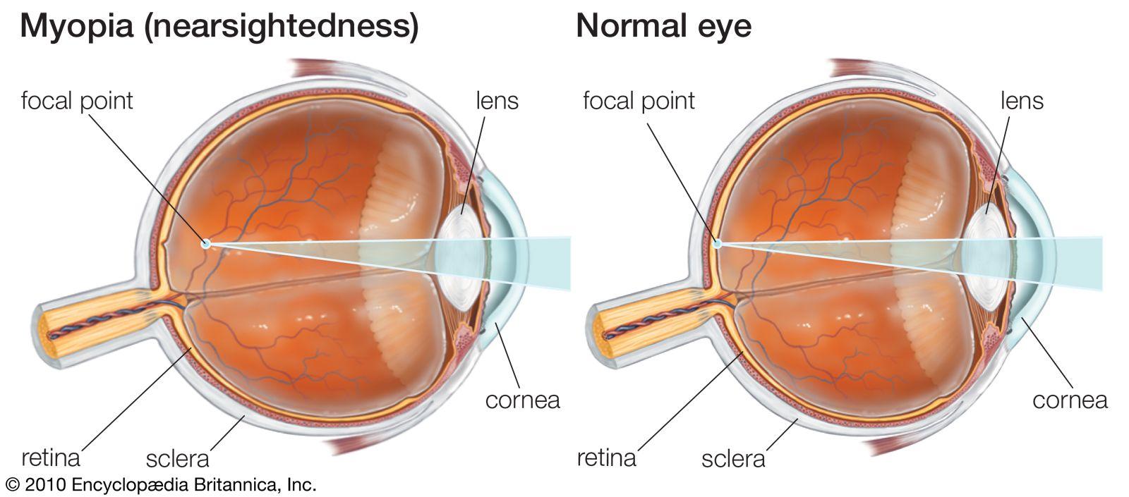 Myopia | Definition & Treatment | Britannica