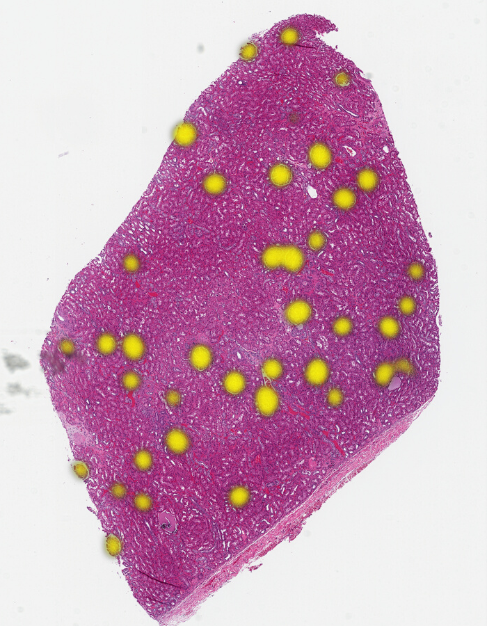 The sample renal tissue with all of the glomeruli located using cosine similarity and the Gigapath foundation model
