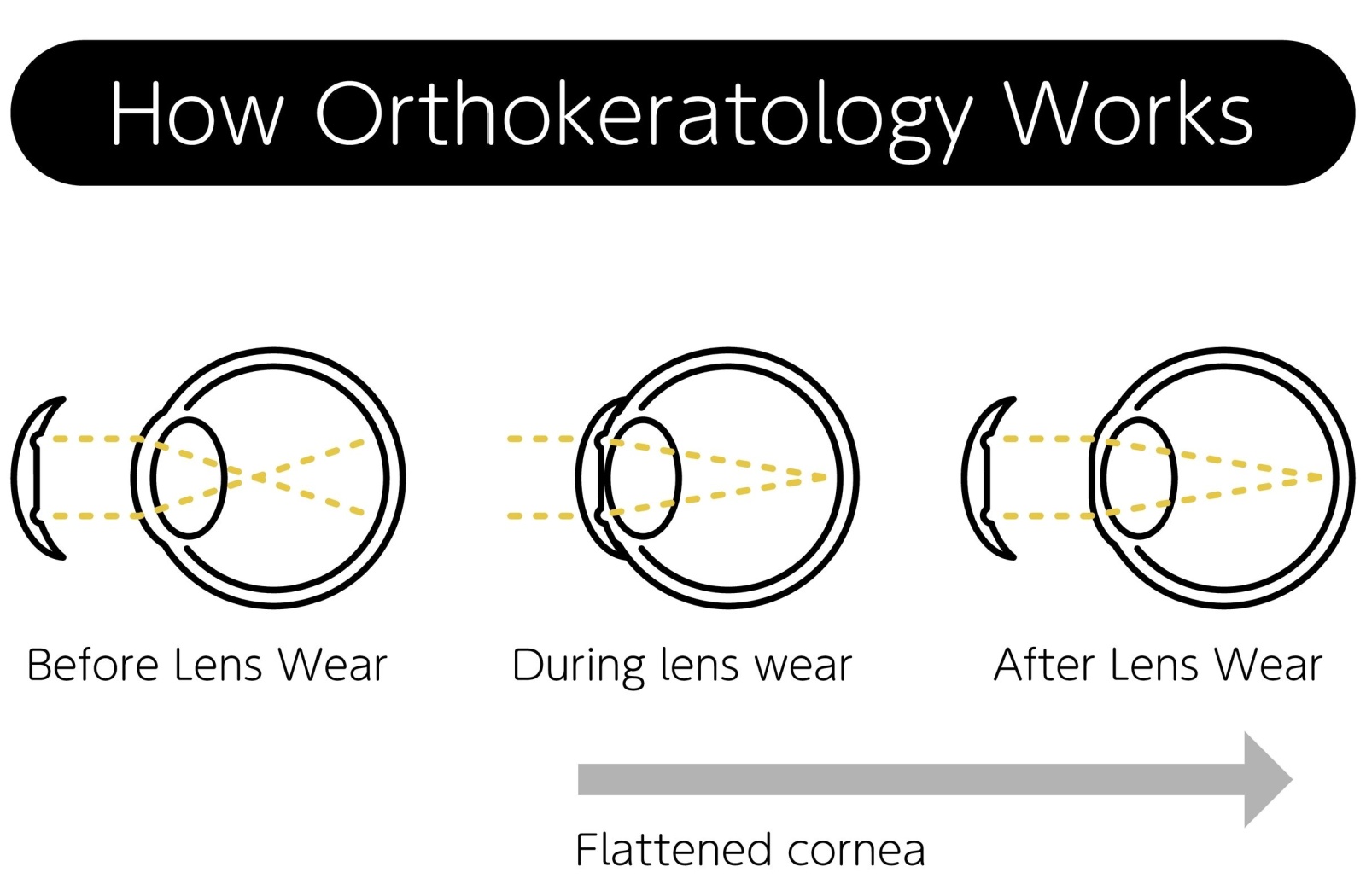 A diagram depicting how orthokeratology works to reshape the cornea, improving myopia symptoms