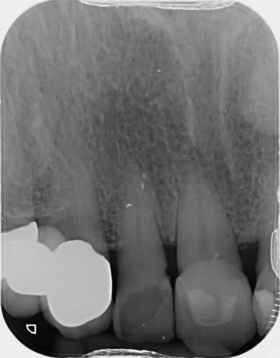 Periapical X-ray