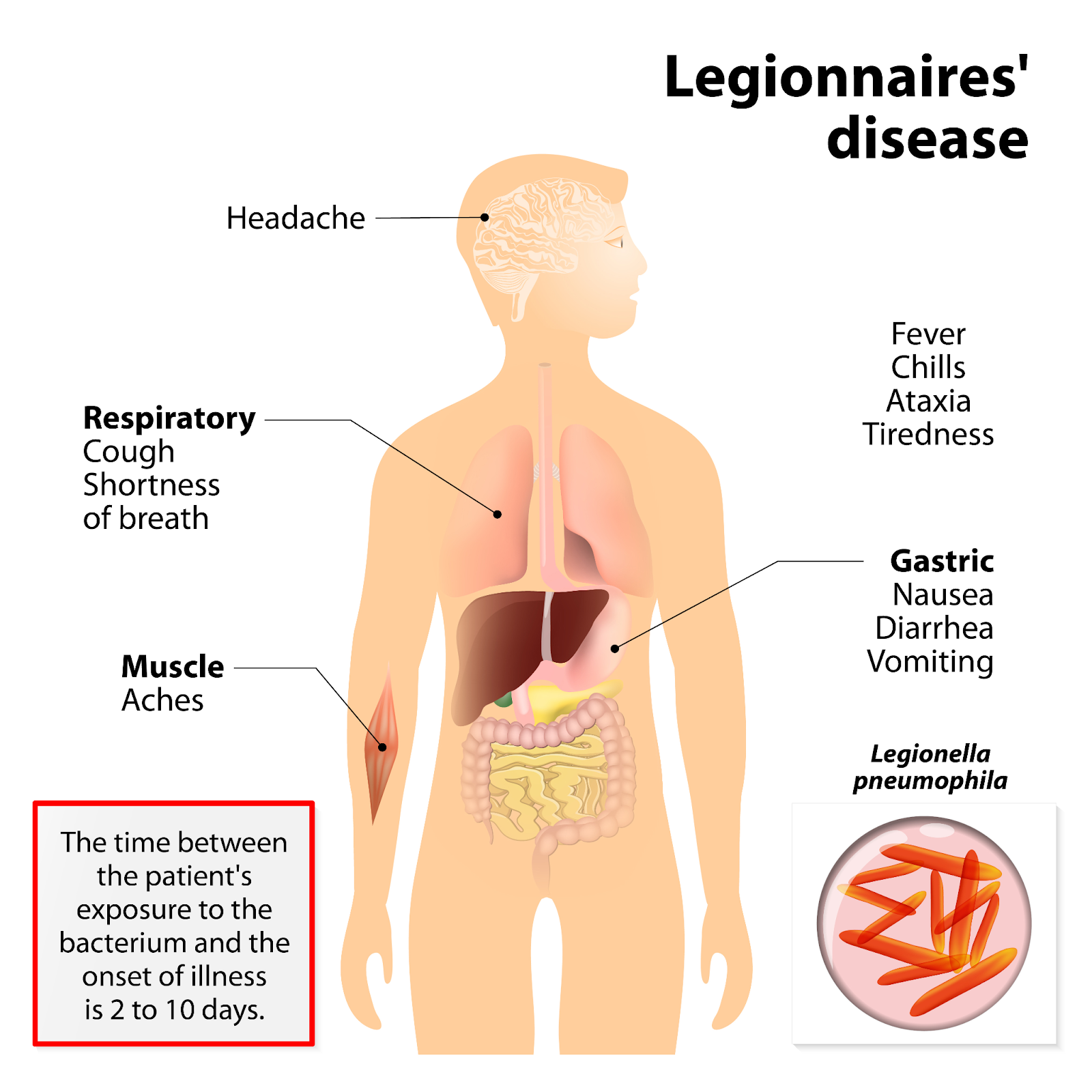 Legionnaires' disease