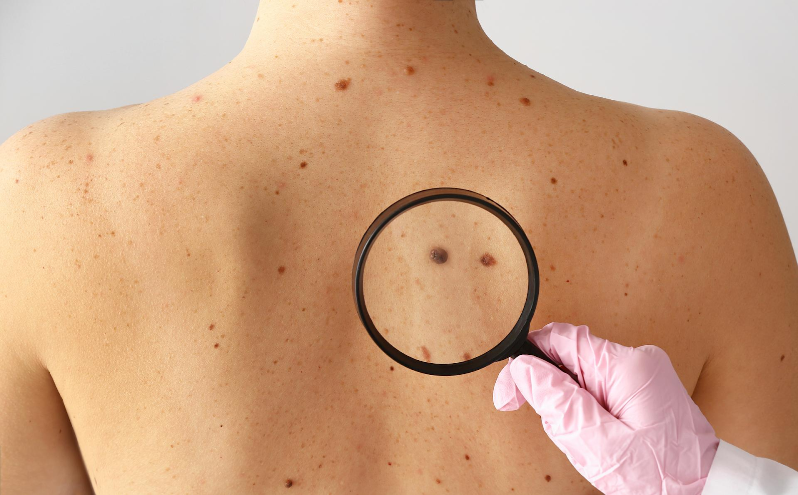 importance of sunscreen