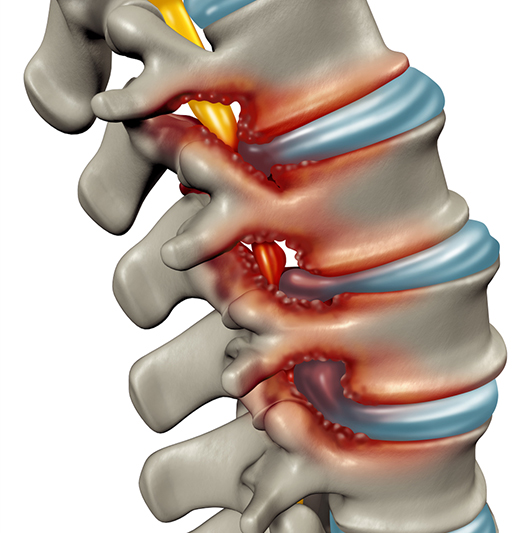 a spine with arthritis and stenosis