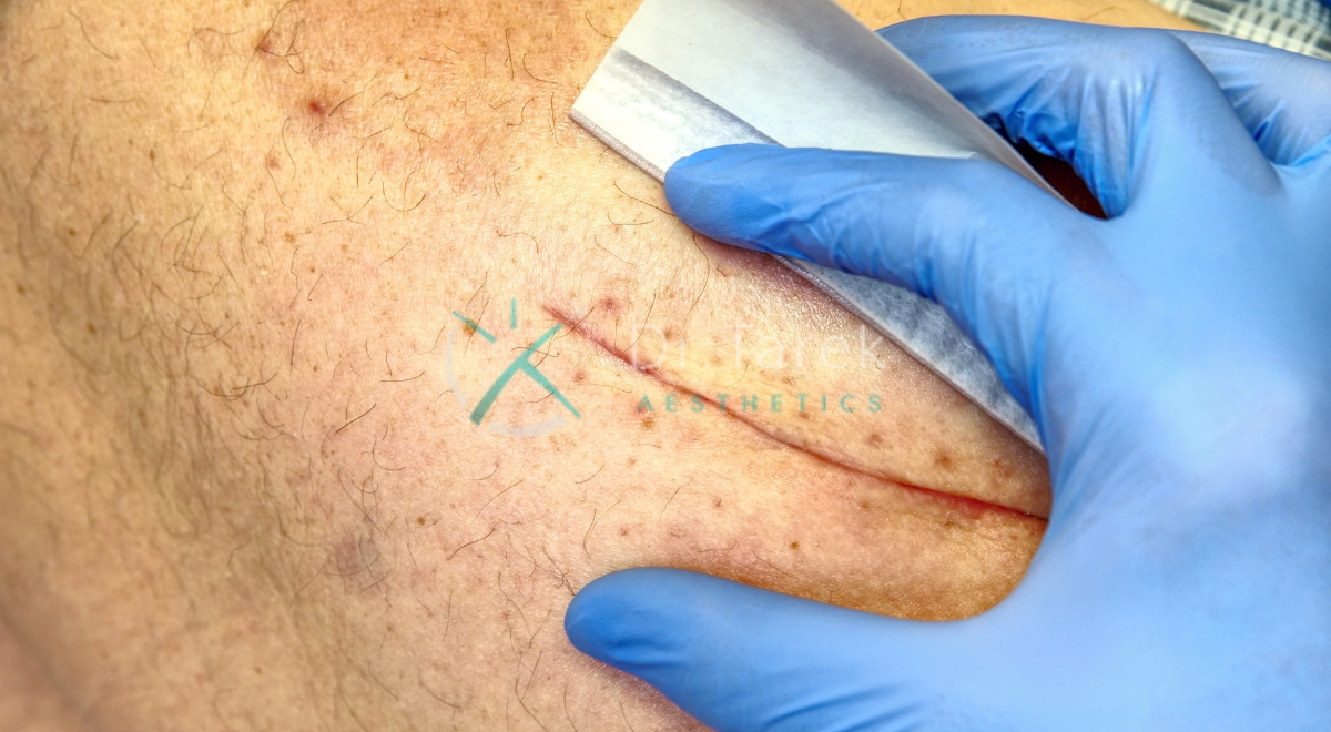 Where Are Liposuction Scars 5 Dr. Tarek Aesthetics | Best Plastic Surgeon In Dubai Where Are Liposuction Scars