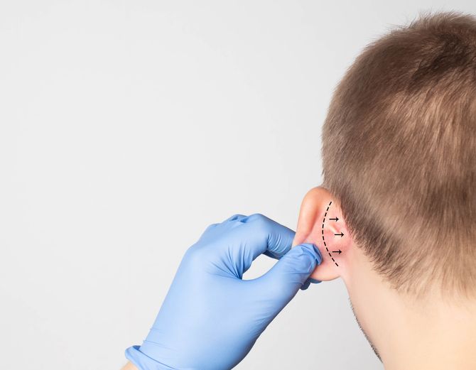 Back of the head image of a child showing Otoplasty incision site