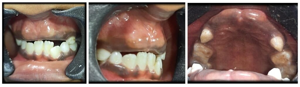 permanent incisors