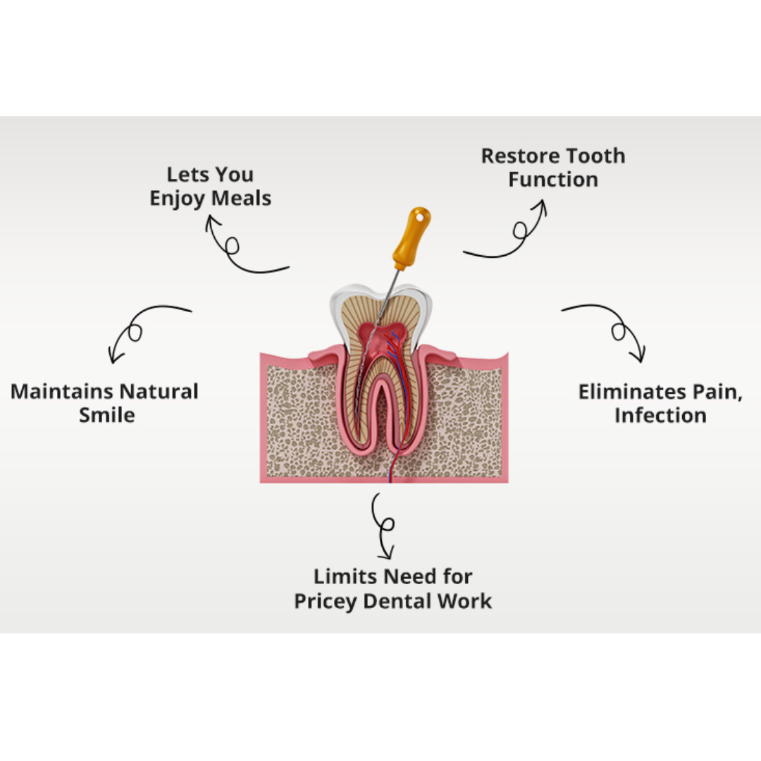 Incisor Root Canal: Ensuring a Healthy Smile