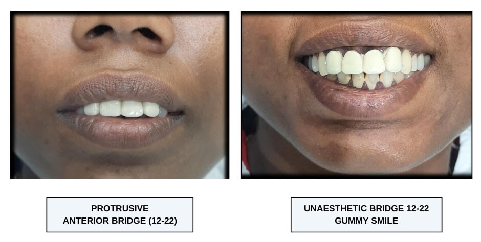 protrusive anterior bridge