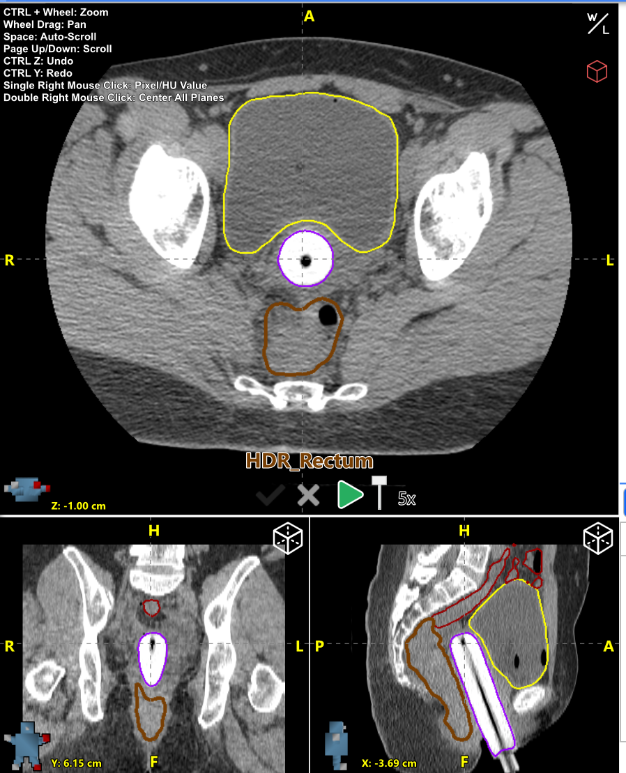 HDR Brachytherapy Radformation