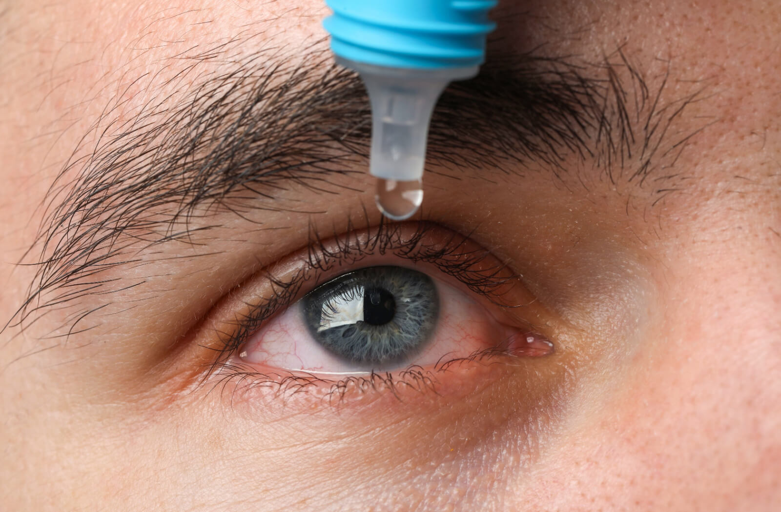 A close-up image of a person's right eye as they insert eye drops to reduce inflammation.