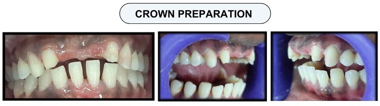 dental crown preparation