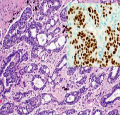 Adenocarcinoma (Glands)