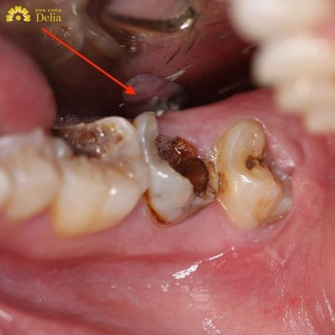 Vi khuẩn sâu răng khiến răng chỉ còn chân