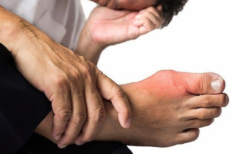 10 điều cần biết về các biến chứng của bệnh gout