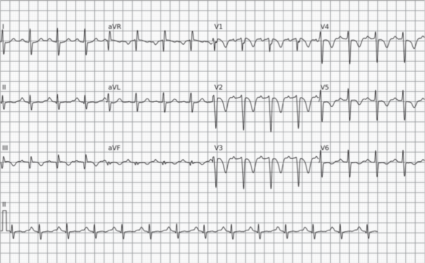 Eletrocardiograma (ECG) com o padrão S1Q3T3