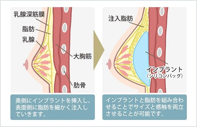 ハイブリッド豊胸術