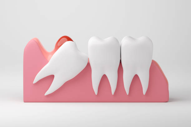 A teeth model used by dentists to show the depiction of wisdom teeth, helping patients understand their position and removal.