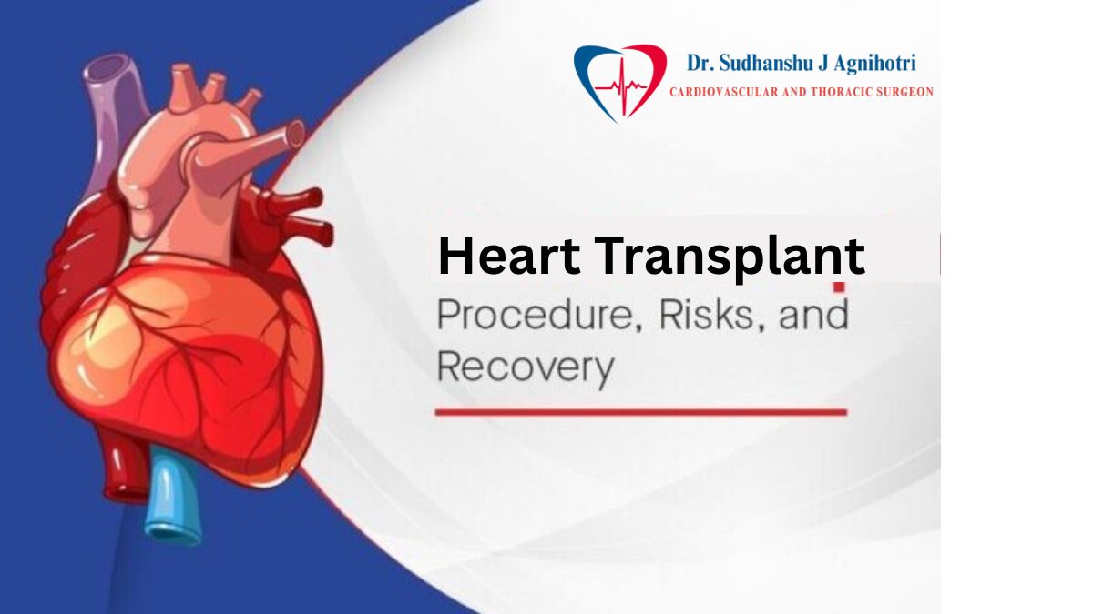 Heart Transplant by Dr Sudhanshu J Agnihotri, a top 10 cardiologist in indore