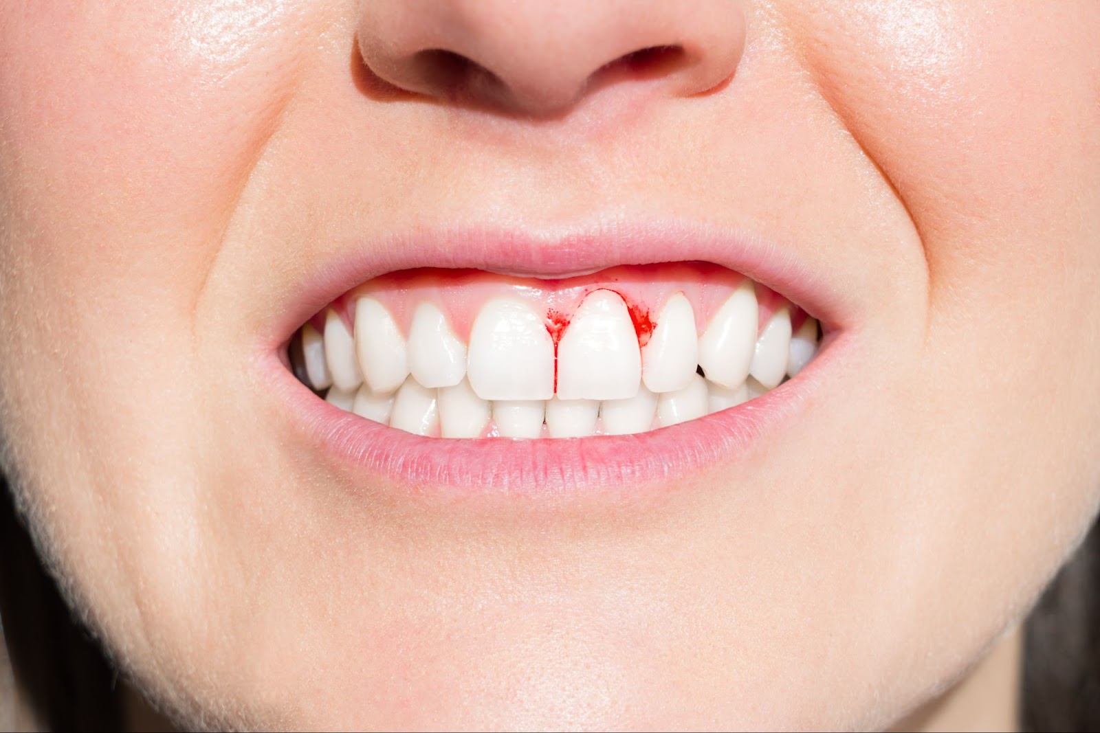 A close-up image of a woman's irritated, bleeding gums.