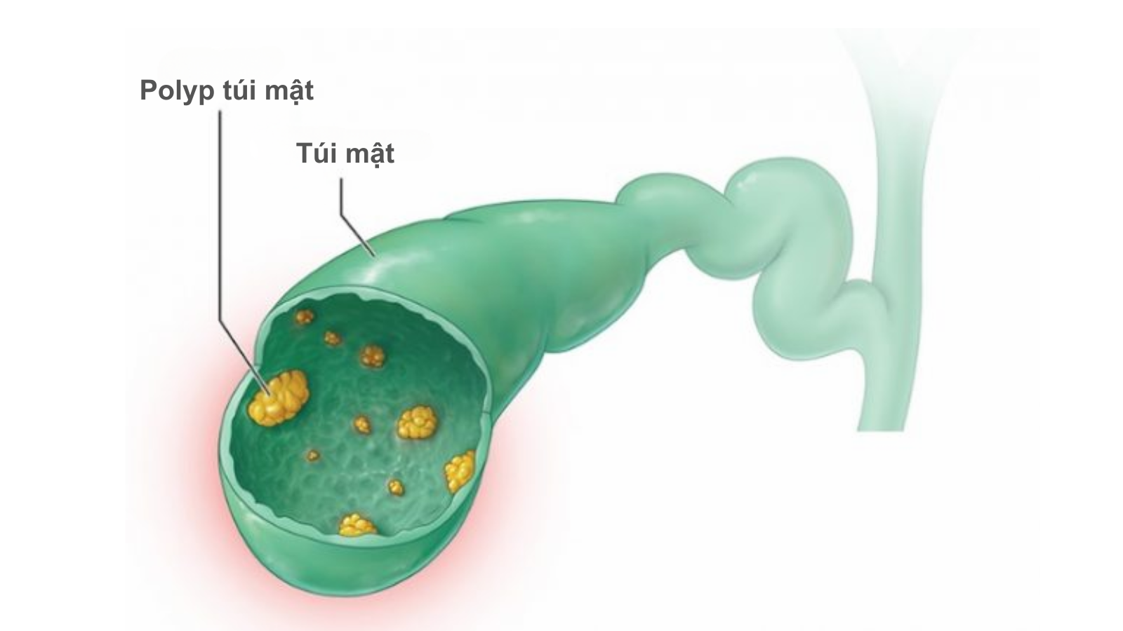 polyp-tui-mat-6mm-co-nguy-hiem-khong 1