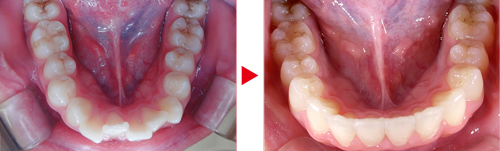 症例03矯正写真（下）、治療前→治療後
