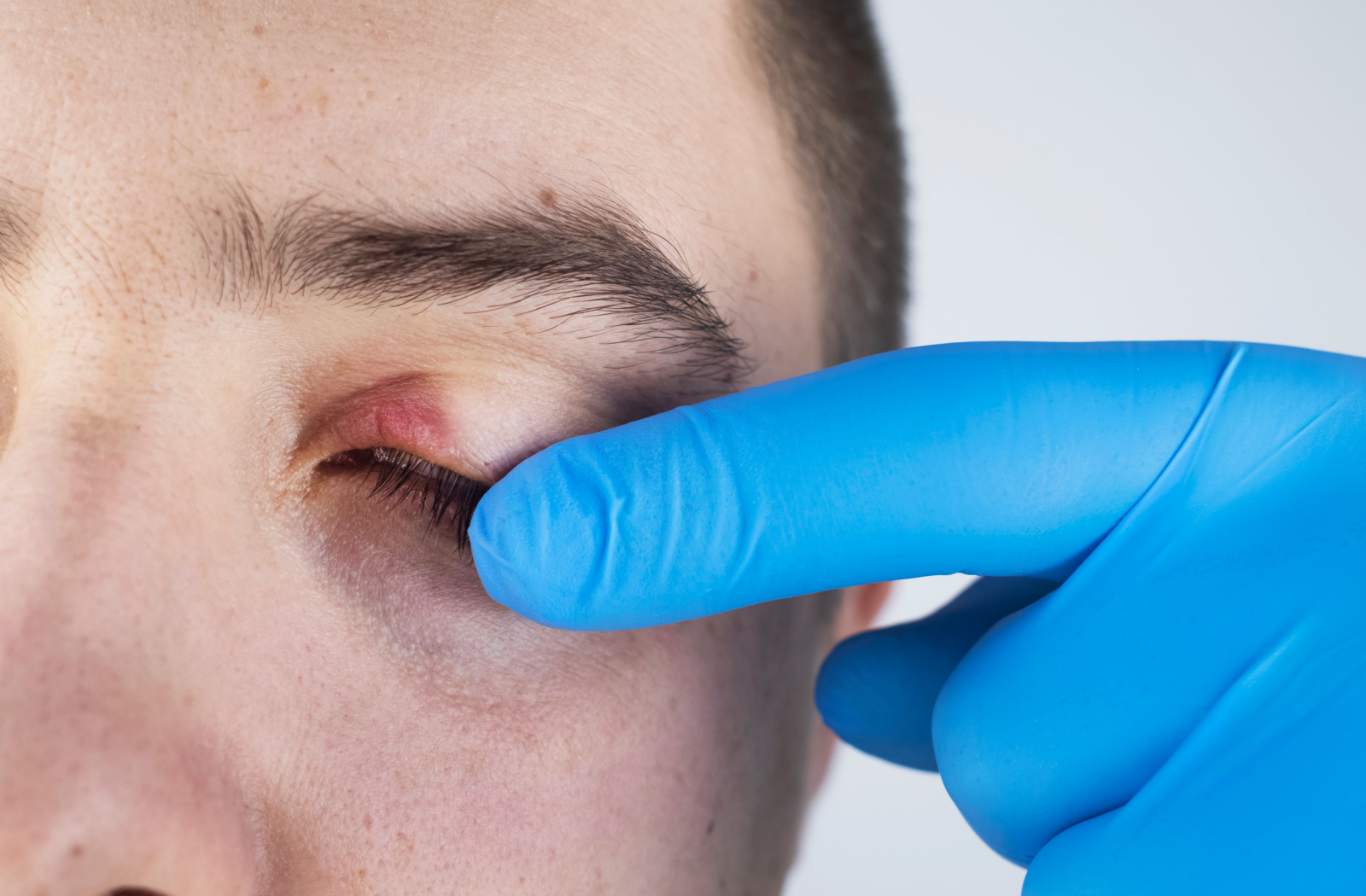 A gloved hand gently exposes a patient's inflamed eyelid.